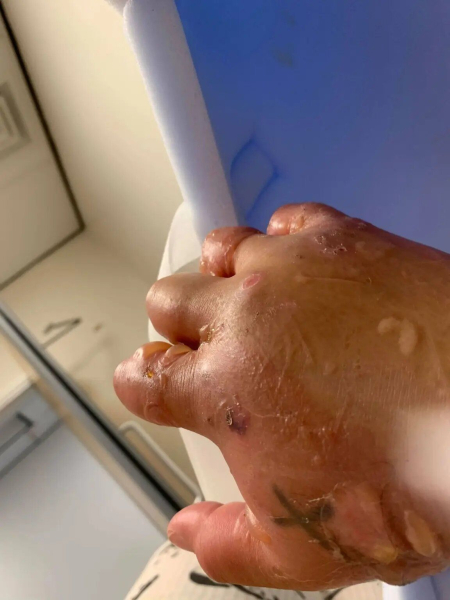 Eine Frau berührte einen giftigen Busch und „verwandelte sich in einen Teletubby“: Was ist mit ihr passiert (Foto)“ /></p>
<p>„In den ersten Tagen, in denen ich bewusstlos war, wurde sie eingecremt , folgten, damit ich keine Schmerzen hatte, und sie warteten darauf, ob ich mich erholen würde. Ich schaute erst im Krankenhaus in den Spiegel und die rechte Seite meines Gesichts war so geschwollen, dass ich wie ein Teletubby aussah. “sagte Sabina.</p>
<p >Ärzte verbanden ihre Wunden und gaben ihr Schmerzmittel. Die Reaktion verursachte auch ein Blutgerinnsel in ihrer Wirbelsäule und das Gehen wurde sehr schmerzhaft.</p>
<p><img decoding=