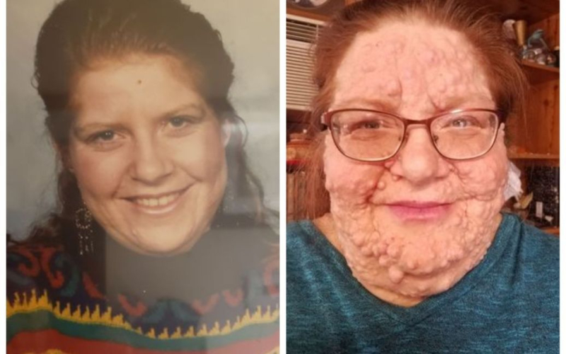 Eine Frau hat Hunderte von Tumoren im Gesicht: Sie sprach über ihre seltene Krankheit und Spott />< /p></p>
<p><strong>Sie reagierte auf die Hasser.</strong></p>
<p>Eine Frau, die mehr als zweihundert Tumore an ihrem Körper wachsen ließ, sprach über ihre seltene Krankheit und Mobbing.</p>
<p>Dies wurde von dailystar.co.uk geschrieben.</p>
<p>Mercedes Christesen leidet an Neurofibromatose Typ 1, einer genetischen Krankheit, die zum Wachstum gutartiger Tumore entlang menschlicher Nerven führt.</p>
<p> > </p>
<p>Die Frau hatte nur vier oder fünf Tumoren als bei ihr im Alter von 19 Jahren die erste Diagnose gestellt wurde, die laut Ärzten nicht schwerwiegend war.</p>
<p><img decoding=