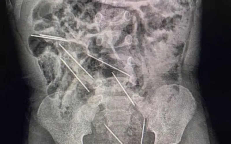 Ein zweijähriger Junge 8 Nadeln verschluckt (Foto)“ /></p>
<p><strong>Er wurde gerettet.</strong></p>
<p>In Peru verschluckte ein zweijähriger Junge versehentlich 8 Nadeln.< /p> </p>
<p>NYpost schreibt darüber. com.</p>
<p>Zum Glück für Narly Piscos Mutter geht es ihrem Sohn gut. Letzte Woche wurde der Junge von einer Farm in der Provinz Mariscal Cáceres zur lebensrettenden Operation in ein Krankenhaus in Tarapoto gebracht.</p>
<p>Eine Röntgenaufnahme seines Bauches zeigte acht Nadeln, die die Ärzte in weniger als zwei Stunden entfernten.</p>
<p><img decoding=