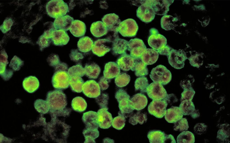 Ein Ein- Einjähriger Junge wurde getötet, Amöbe frisst das Gehirn: Symptome der Krankheit“ /></p>
<p><strong>In den USA tötete die Amöbe Naegleria fowleri ein einjähriges Kind.</strong>< /p></p>
<p>In Arkansas, <strong>USA</strong>, starb am 4. September ein einjähriger Junge an einer seltenen Naegleria fowleri-Infektion. Das Kind hat sich wahrscheinlich bei einer Wasserfahrt in einem Country Club infiziert.</p>
<p>CNN schreibt darüber.</p>
<p><strong>Naegleria fowler</strong> ist eine Amöbe, die das Gehirn frisst. Dabei wird das Gewebe zerstört, was zu Schwellungen und in der Regel zum Tod führt. Es lebt im Boden und in warmen Süßwasserseen, Flüssen, Teichen und heißen Quellen.</p>
<p>In seltenen Fällen haben sich Menschen laut CDC mit Naegleria fowleri über Freizeitwasser infiziert, das nicht genügend Chlor enthält, etwa in Schwimmbädern oder Surfparks.</p>
<p>Laut CDC ist dies eine Infektion mit Naegleria fowleri ist in den Vereinigten Staaten selten und betrifft nur etwa drei Menschen pro Jahr, aber solche Fälle enden normalerweise tödlich.</p>
<p>Der 16 Monate alte Junge starb, nachdem er mehrere Tage im Krankenhaus verbracht hatte, sagte Jaron Hobbs, Gerichtsmediziner im Pulaski County sagte. Das Gesundheitsministerium des Bundesstaates untersuchte und kam zu dem Schluss, dass sich das Opfer die Infektion vermutlich auf dem Wasserspielplatz des Little Rock Country Club zugezogen hatte.</p>
<p>Das Gesundheitsministerium des Bundesstaates teilte mit, dass mehrere Proben aus der Wasserattraktion und dem Pool zur Auswertung an die Zentren für die Kontrolle und Prävention von Krankheiten geschickt wurden. Somit enthielt eine Probe lebensfähige Naegleria fowleri.</p>
<h2><strong>Was über Naegleria fowleri bekannt ist</strong></h2>
<p>Nach Angaben der Centers for Disease Control and Prevention (CDC) ist dies Eine Art Amöbe dringt über die Nase in den Körper ein, am häufigsten, wenn Menschen schwimmen, tauchen oder ihren Kopf in Süßwasserkörper eintauchen.</p>
<p>Sobald die Amöbe in das Gehirn eindringt, zerstört sie Gehirngewebe und verursacht eine fast immer tödliche Infektion, die als primäre Amöben-Meningoenzephalitis (PAM) bezeichnet wird. Eine Infektion mit Naegleria fowleri wird nicht von Mensch zu Mensch übertragen.</p>
<p>Symptome von PAM treten normalerweise fünf Tage nach der Infektion auf, können aber auch nach einem bis zwölf Tagen beginnen.</p>
<p>Zu den Symptomen gehören Kopfschmerzen, Fieber, Übelkeit oder Erbrechen. Es kann auch zu Verwirrtheit, Nackensteifheit, Unaufmerksamkeit gegenüber der Umgebung und Menschen, Krampfanfällen, Halluzinationen und Koma kommen.</p>
<p>Die Krankheit schreitet schnell voran und führt normalerweise innerhalb von etwa fünf Tagen zum Tod.</p>
<p > Das CDC sagt, dass der beste Weg, Infektionen beim Schwimmen im Süßwasser vorzubeugen, darin besteht, Wasser aus der Nase fernzuhalten. Es wird auch empfohlen, das Aufwirbeln von Sedimenten am Grund eines Süßwasserkörpers zu vermeiden, wo Amöben mit größerer Wahrscheinlichkeit leben.</p>
<p>Erinnern Sie sich daran, dass ein<strong>zweijähriger Junge 8 Nadeln verschluckt hat ( Foto).</strong></p>
<h4>Verwandte Themen:</h4>
<p>Weitere Neuigkeiten</p>
<!-- relpost-thumb-wrapper --><div class=